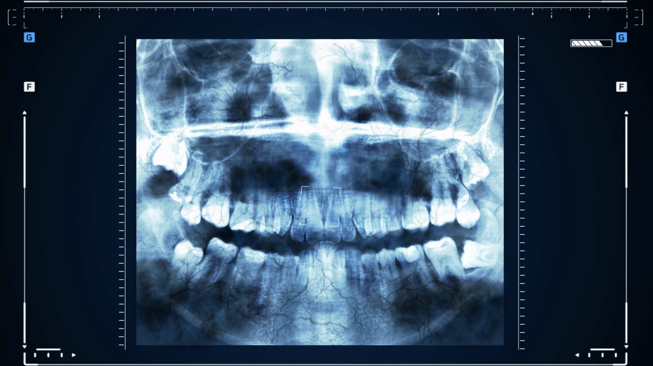 Still image of an x-ray of a mouth filled with teeth.